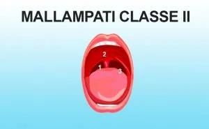 Mallampati classe II