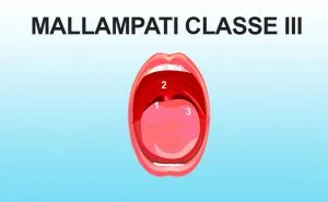 Mallampati classe III