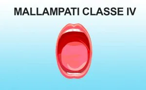 Mallampati classe IV