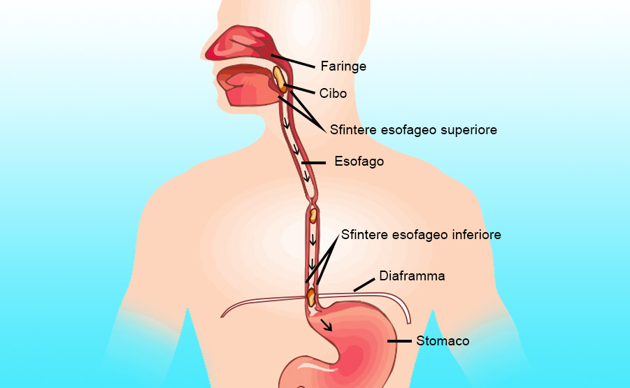 Acalasia esofagea