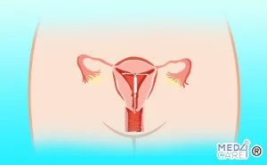 Scopri di più sull'articolo Dispositivi intrauterini o IUD