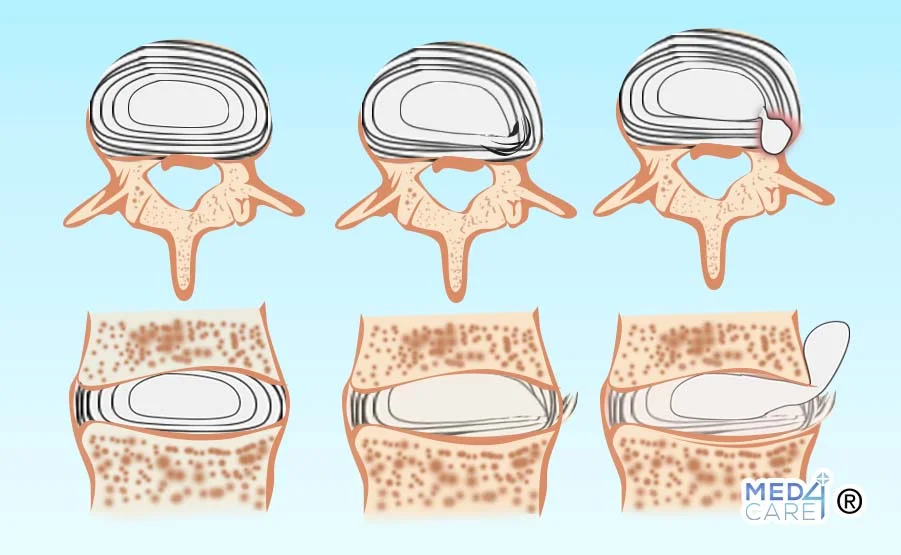 Ernia lombare, ernia contenuta, ernia espulsa, ernia migrata
