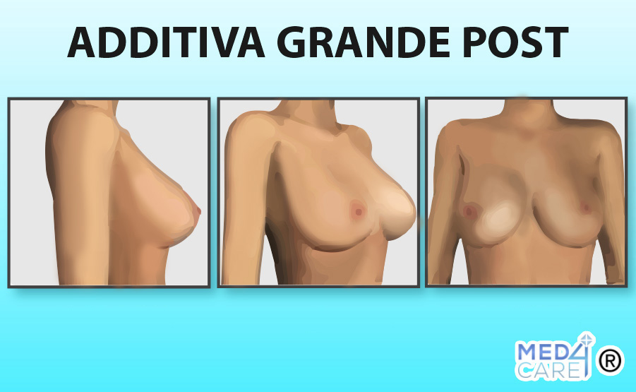 Additiva Grande dopo, mastoplastica additiva