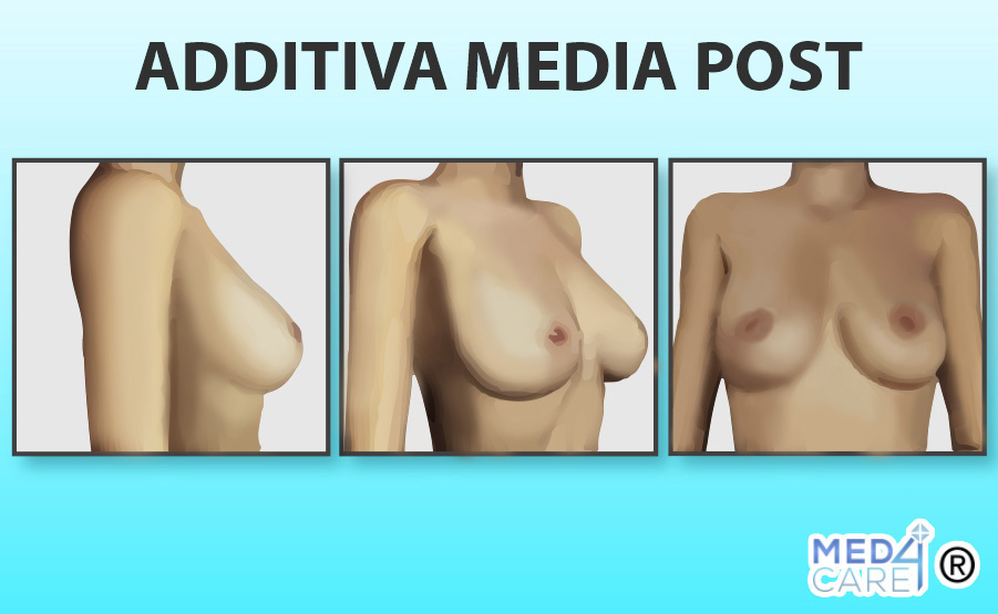 Additiva Media dopo, mastoplastica additiva