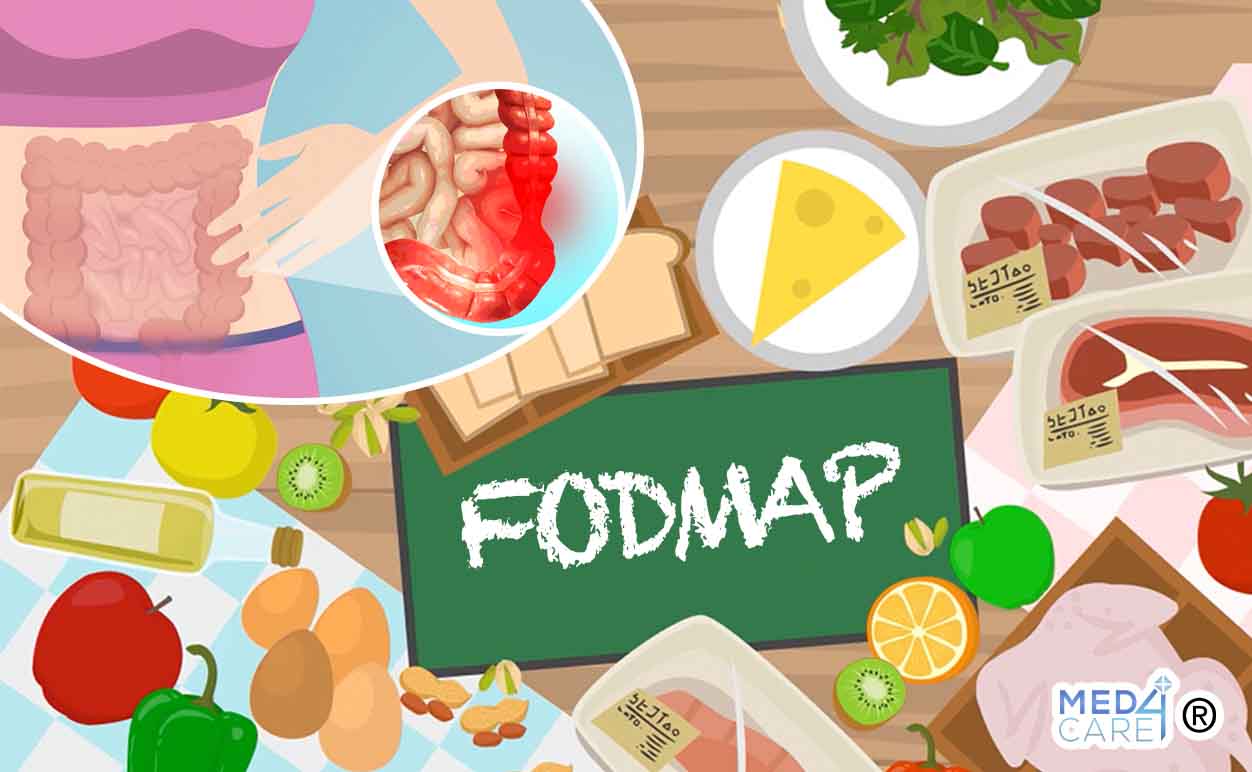 low-fodmap intestino irritabile