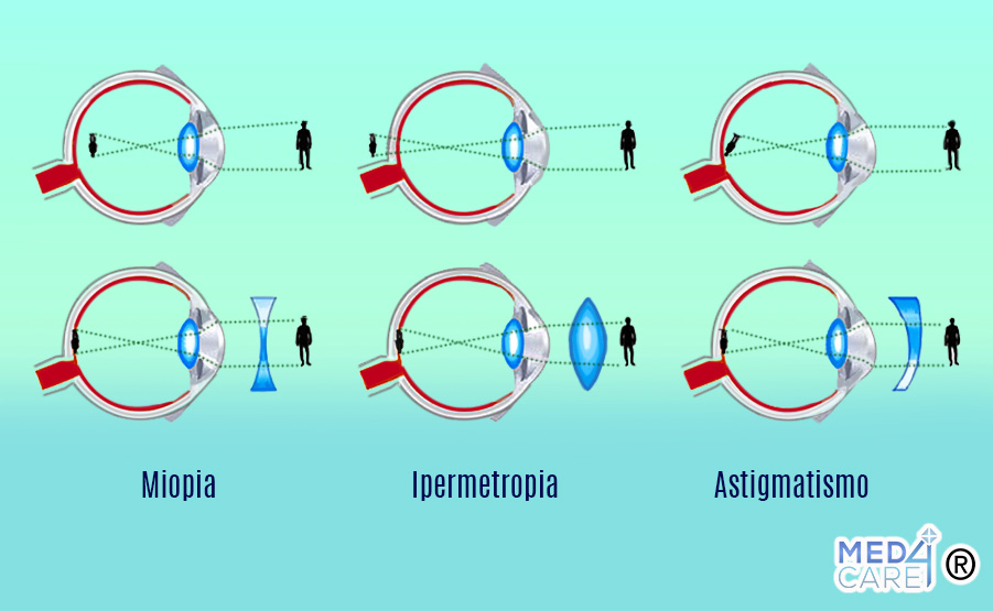 Miopia, astigmatismo, ipermetropia, ametropie