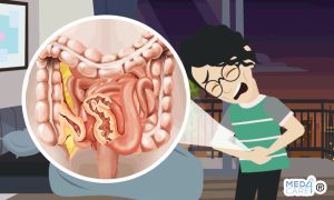 Scopri di più sull'articolo Morbo di Crohn