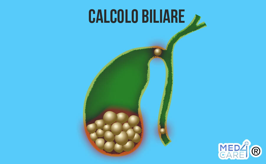 Calcoli Colecisti