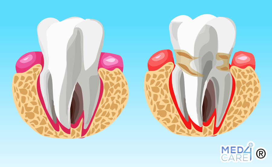 parodontite, infiammazione gengivale, confronto con dente sano