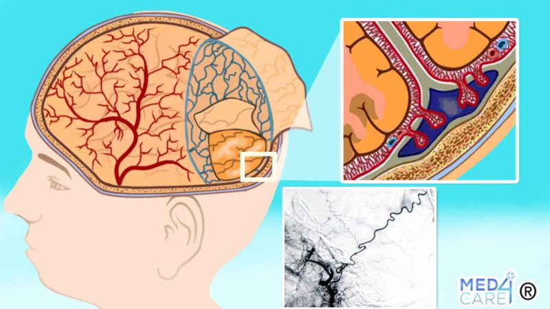 Embolizzazione MMA per ematoma subdurale cronico