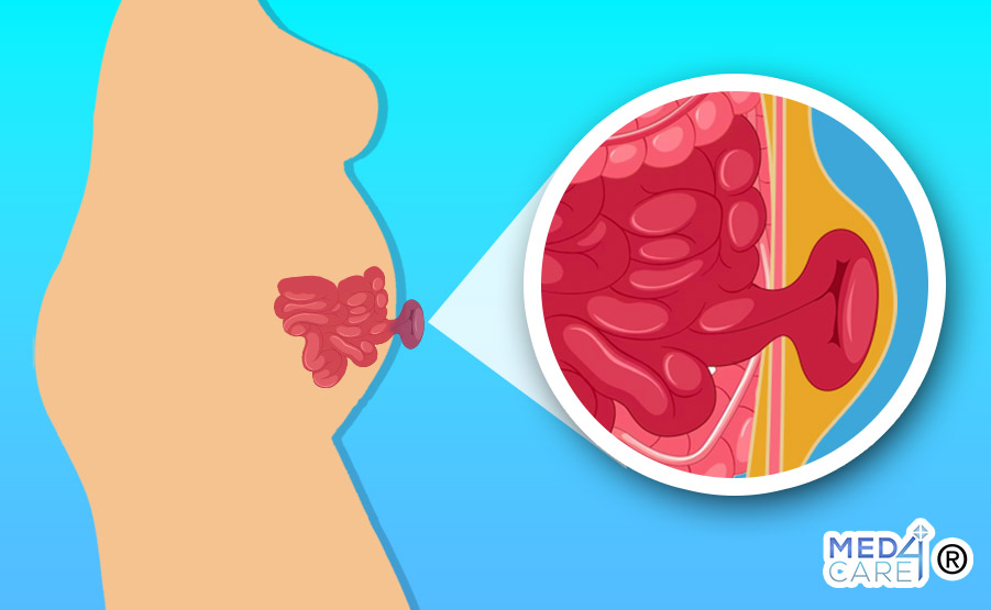 ernia ombelicale, ernia