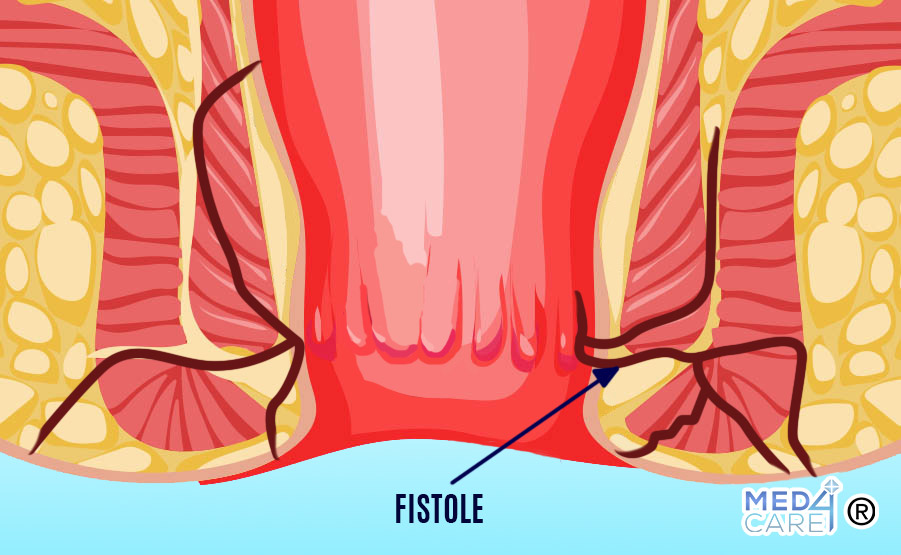 fistole anali, fistola anale, ano, fistola, fistole