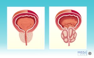 Scopri di più sull'articolo Iperplasia prostatica benigna