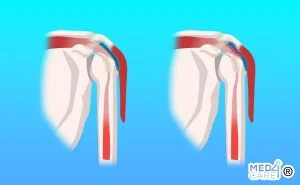 sindrome da impingement subacromiale