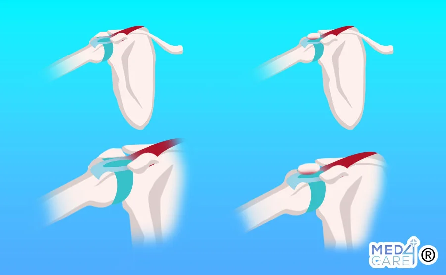 sindrome da impingement subacromiale 