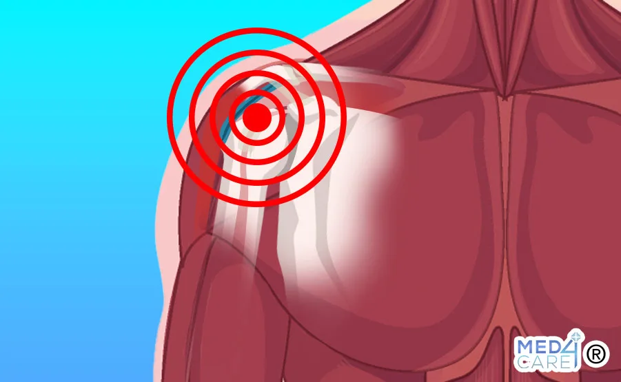 sindrome da impingement subacromiale, sindrome da conflitto acromiale, impingement, dolore alla spalla, spalla dolorosa