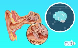 Scopri di più sull'articolo L’intelligenza artificiale può predire il grado di conservazione dell’udito dopo la timpanoplastica?