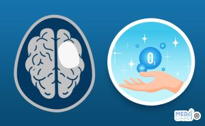 Scopri di più sull'articolo Panoramica sull’uso dell’ozonoterapia per il trattamento del glioma ad alto grado