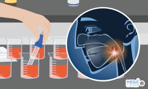 Biopsia liquida e tumori orofaringei, tumori orofaringei, HPV, biopsia liquida, biopsia