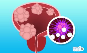 Scopri di più sull'articolo L’immunoterapia aumenta la sopravvivenza dei pazienti affetti da carcinoma in stadio avanzato della vescica?