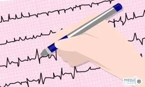 Scopri di più sull'articolo Qual è il miglior trattamento di ablazione per la fibrillazione atriale parossistica?