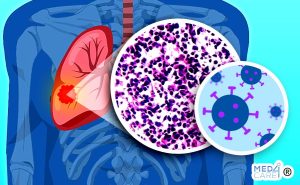 Scopri di più sull'articolo Avanzamenti terapeutici per il microcitoma polmonare: il ruolo della nuova immunoterapia che coinvolge le cellule T