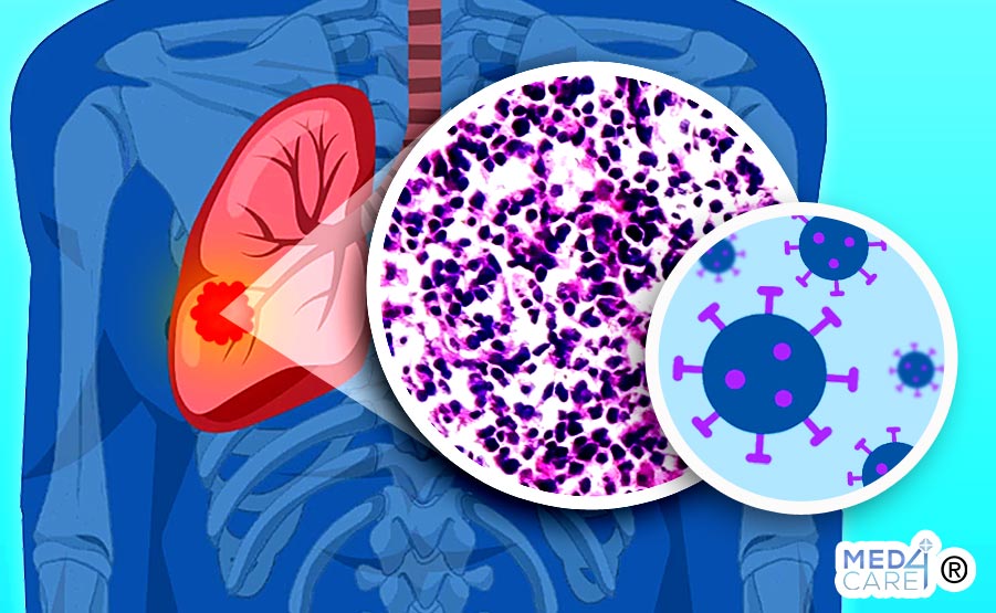 microcitoma polmonare immunoterapia, immunoterapia, microcitoma polmonare