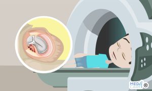 Scopri di più sull'articolo Quanto è utile la RM nel rilevare il colesteatoma residuo dopo l’intervento all’orecchio medio nei bambini?