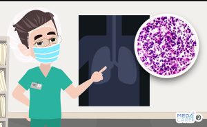 Tumori polmone e terapie biologiche, terapie biologiche, tumori del polmone, polmone, tumori NSCLC del polmone