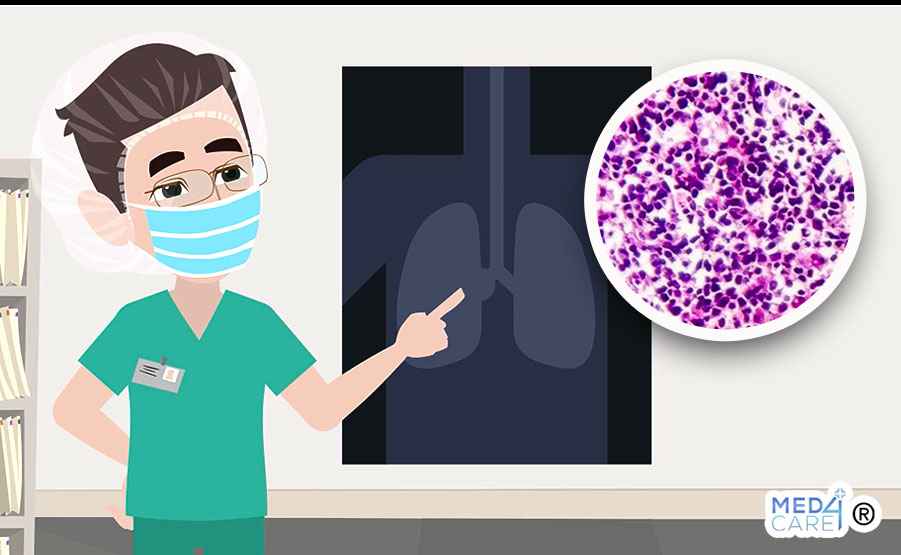 Tumori polmone e terapie biologiche, terapie biologiche, tumori del polmone, polmone, tumori NSCLC del polmone