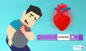 semaglutide rischio cardiovascolare, diabete, obesità, semaglutide, rischio cardiovascolare, infarto, ictus