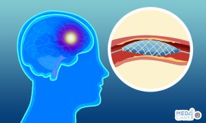 Scopri di più sull'articolo Il doppio trattamento antipiastrinico riduce il rischio di recidiva di ictus?