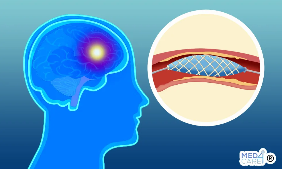 trattamento antipiastrinico recidiva ictus, aspirina, ictus, ictus ischemico, recidiva ictus, doppio trattamento antipiastrinico, attacco ischemico, farmaci anti-aggreganti