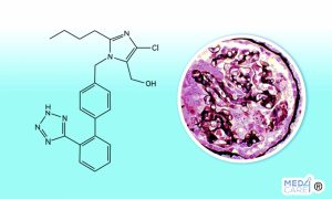 trattamento glomerulosclerosi focale segmentaria, glomerulosclerosi focale segmentaria, insufficienza renale acuta