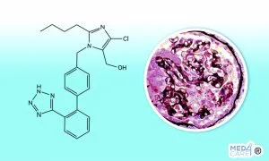 trattamento glomerulosclerosi focale segmentaria, glomerulosclerosi focale segmentaria, insufficienza renale acuta